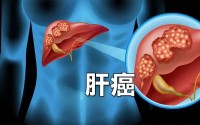 肝癌一般是怎样形成的 症状有那些 (肝癌一般是怎么发现的)